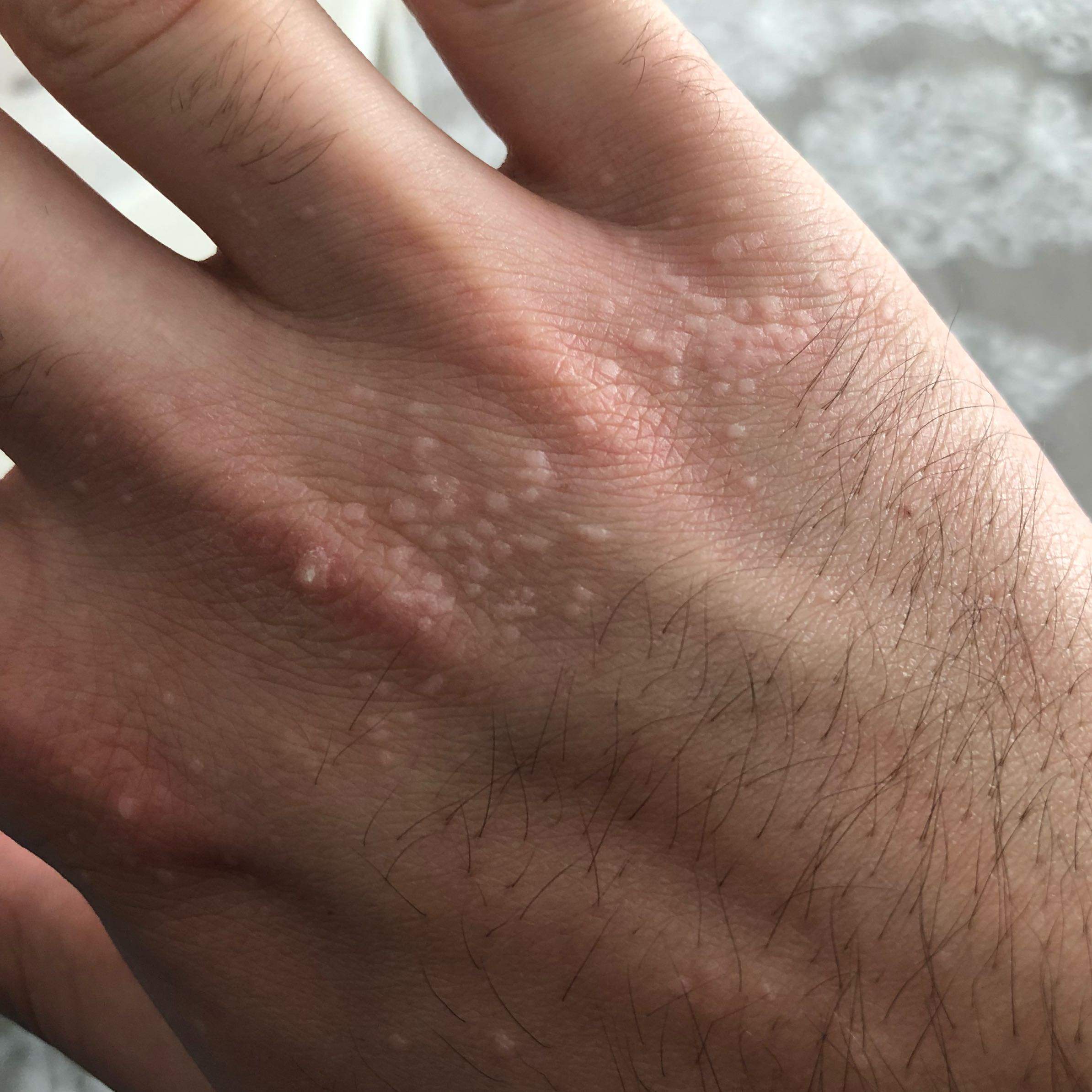 Kleine Harte Weisse Pickel Auf Der Hand Und Korper Gesundheit Und Medizin Haut Weiss Kleine Harte Weisse Pickel Auf Der Hand Und Korper Gesundheit Und Medizin Haut Weiss