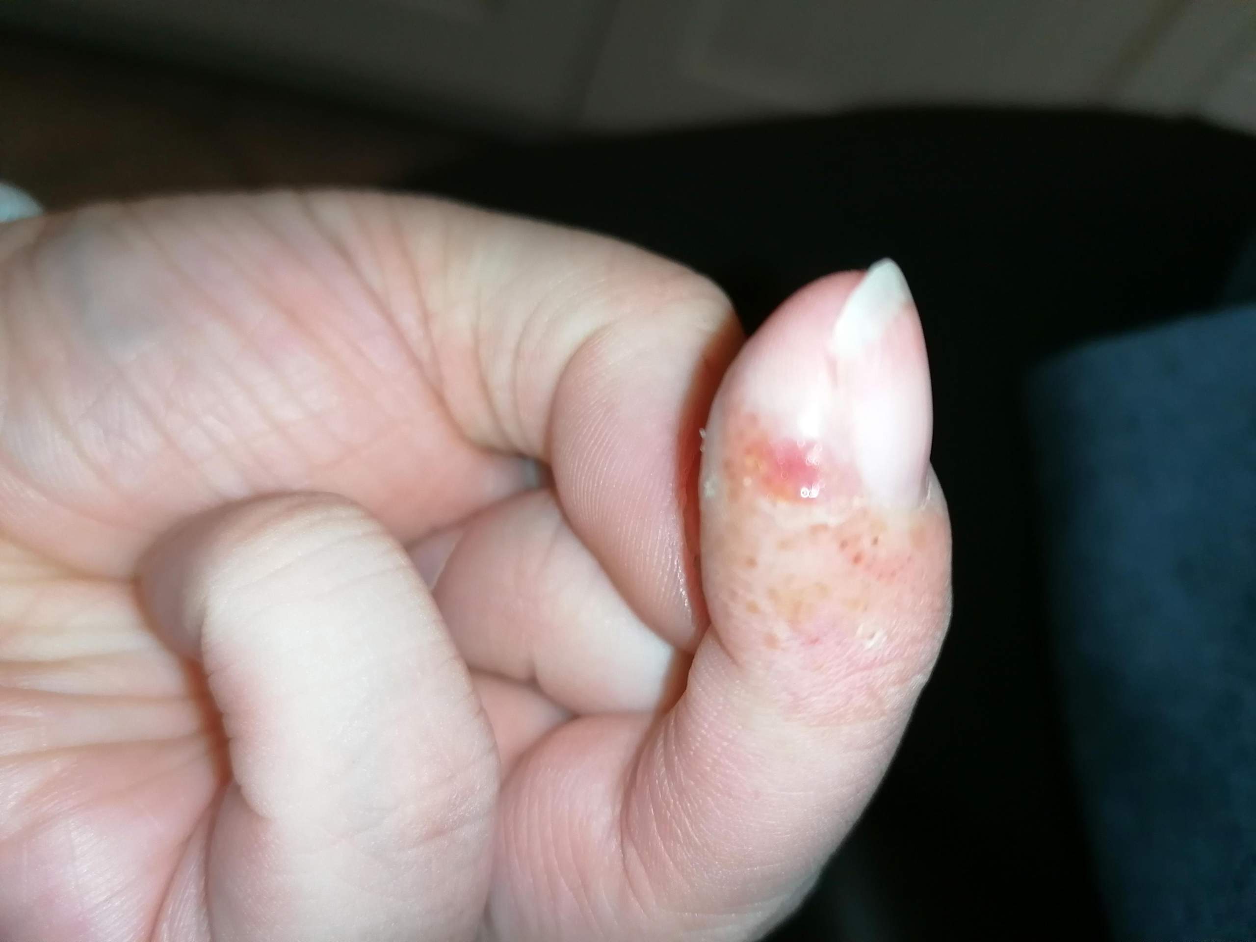 Kleine juckende Bläschen an Fingerkuppe, was ist das...? (Gesundheit