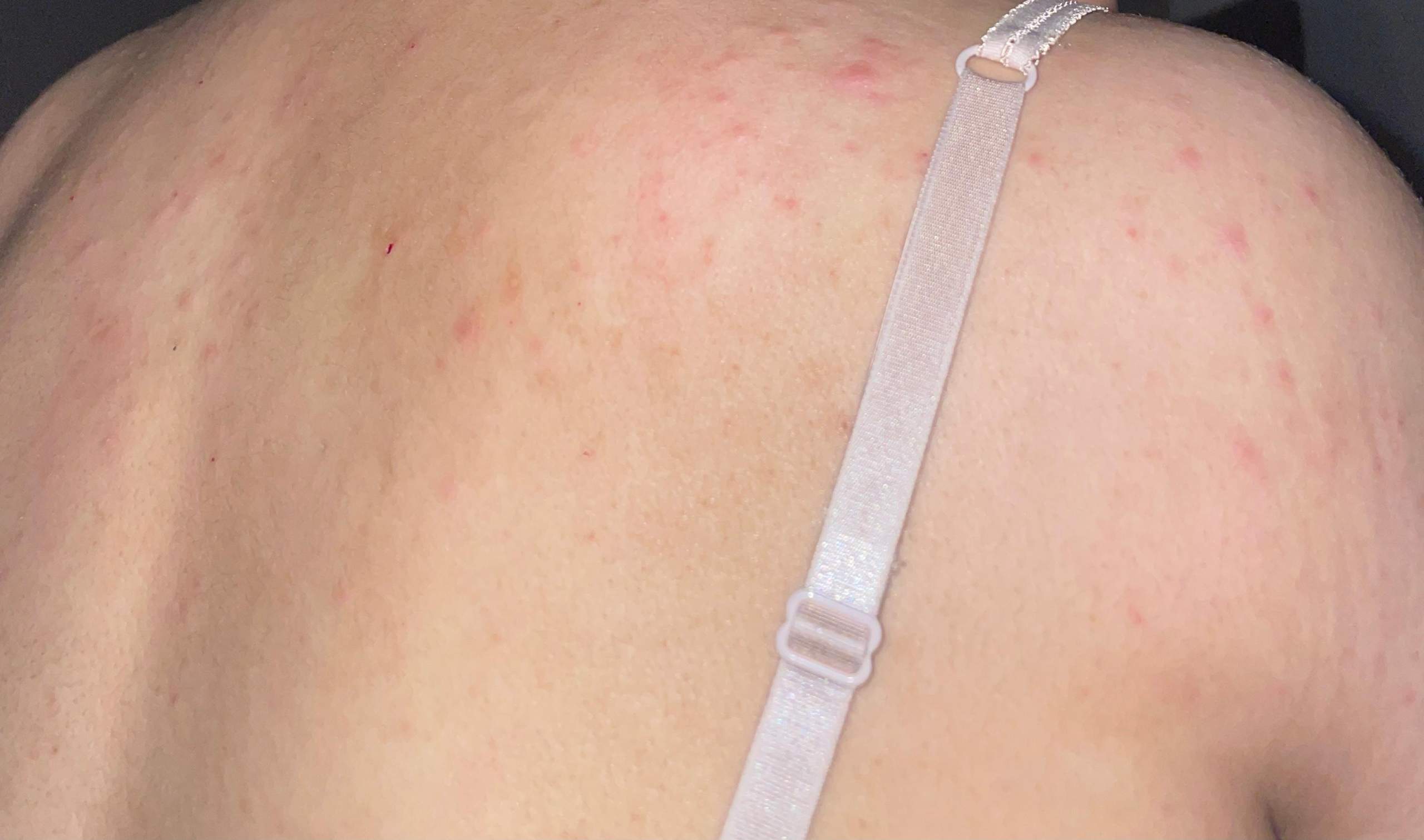 Kleine juckende Pickel am Rücken und Schulter,was kann ich tun ? (Gesundheit und Medizin, Haut pickel an schulter und rücken