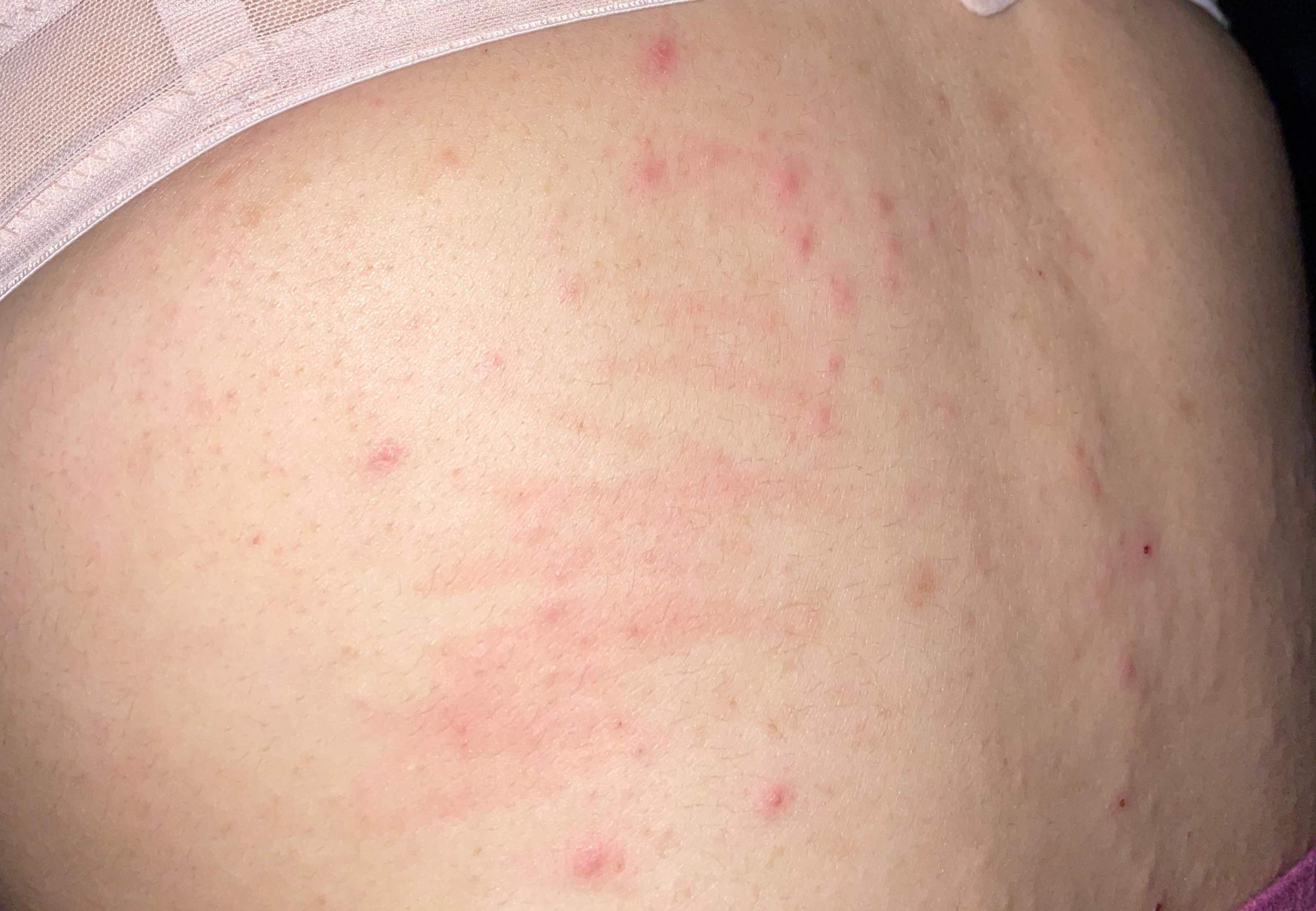 Stress Pickel Was Tun AA0 pickel die weh tun