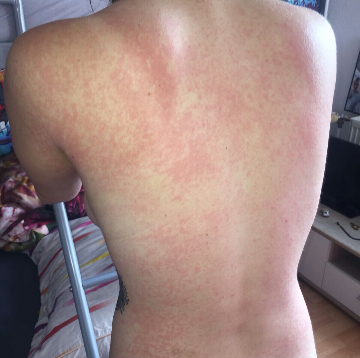 Kleine Juckende Pickel Was Ist Das Haut Jucken Hautausschlag Kleine Juckende Pickel Was Ist Das Haut Jucken Hautausschlag