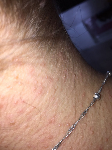 Kleine Juckende Pickel Was Ist Das Haut Jucken Hautausschlag