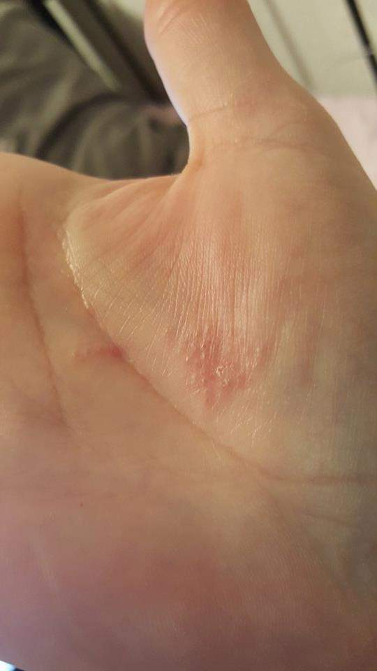 Kleine juckende punkte Handinnenfläche was könnte es sein? (Arzt, Krankheit, Allergie) Kleine juckende punkte Handinnenfläche was könnte es sein? (Arzt, Krankheit, Allergie)