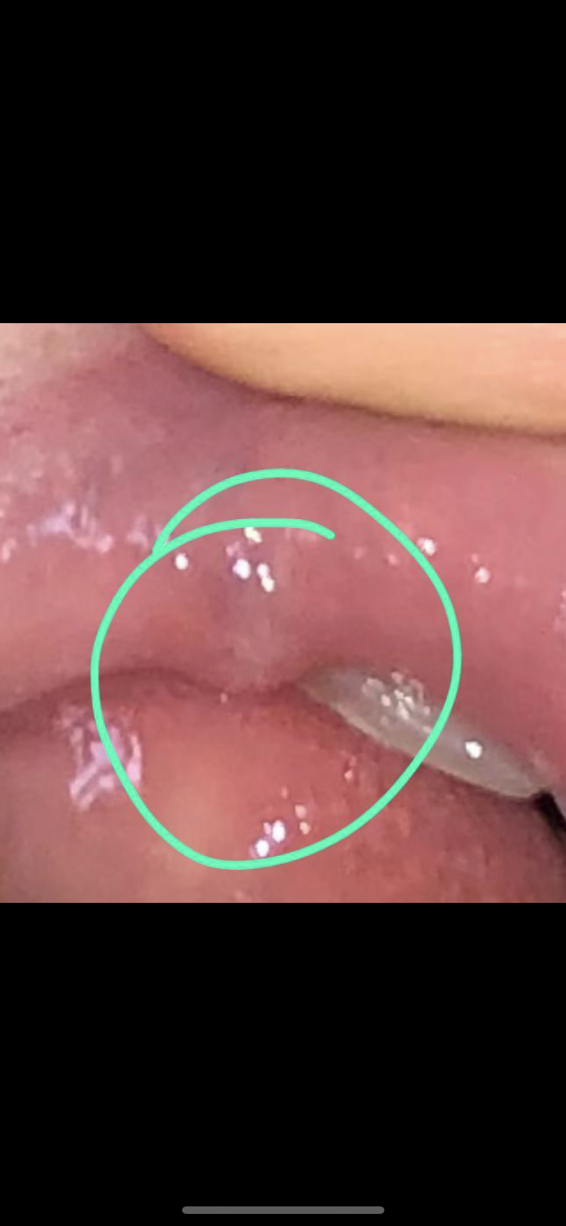 kleine Knoten/Beulen Innenseite Lippe? (Gesundheit und Medizin, Angst)
