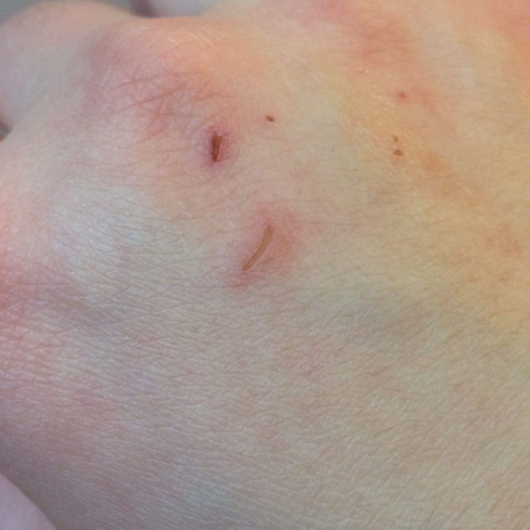 Kleine Kratzer plötzlich auf der hand? (Haut, krank, Verletzung)
