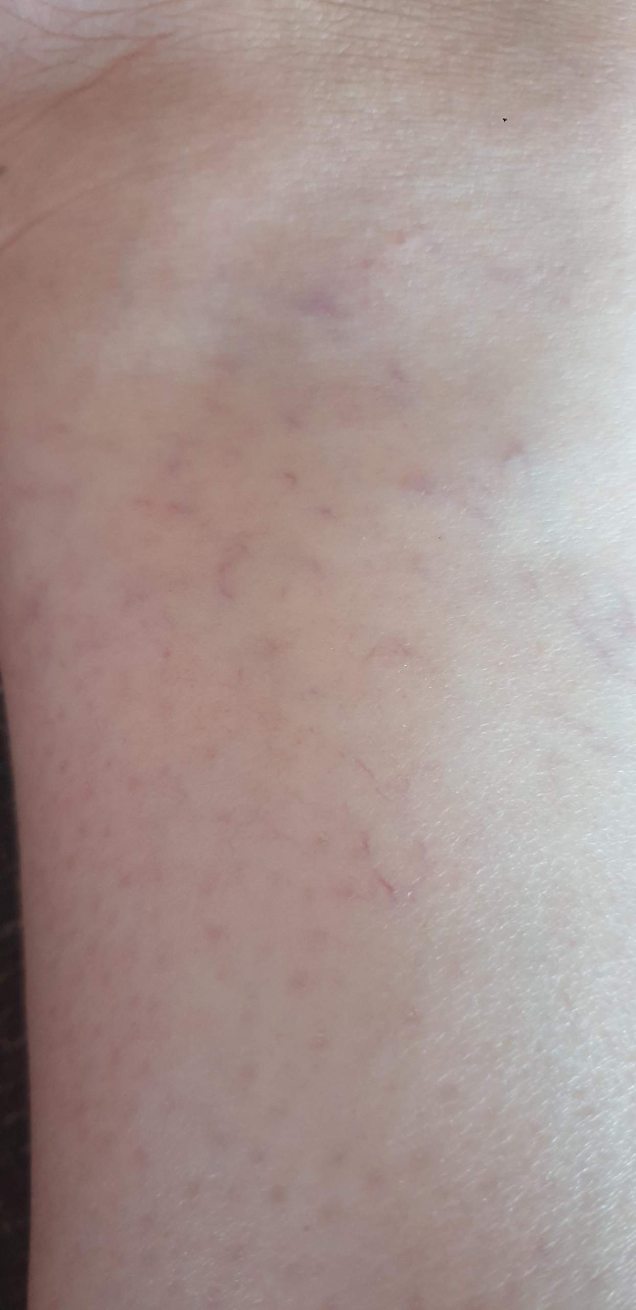 Kleine lila Adern ganz plötzlich? (Gesundheit, Körper, Krankheit)