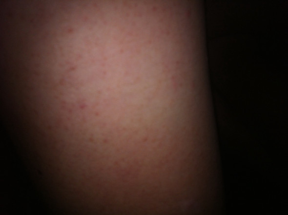 Arm - (Haut, Pickel)