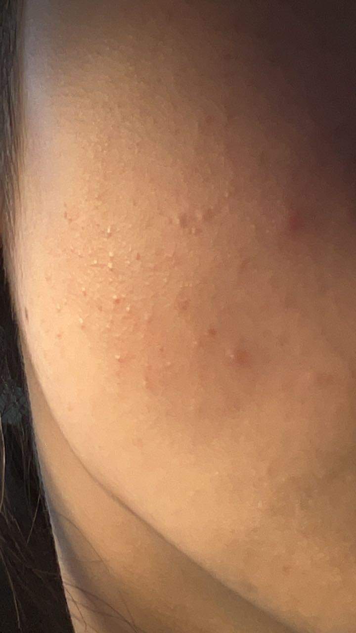 pickel auf der wange loswerden