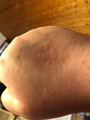 Kleine Pickel Auf Dem Ganzen Handrucken Gesundheit Und Medizin Gesundheit Hand Kleine Pickel Auf Dem Ganzen Handrucken Gesundheit Und Medizin Gesundheit Hand