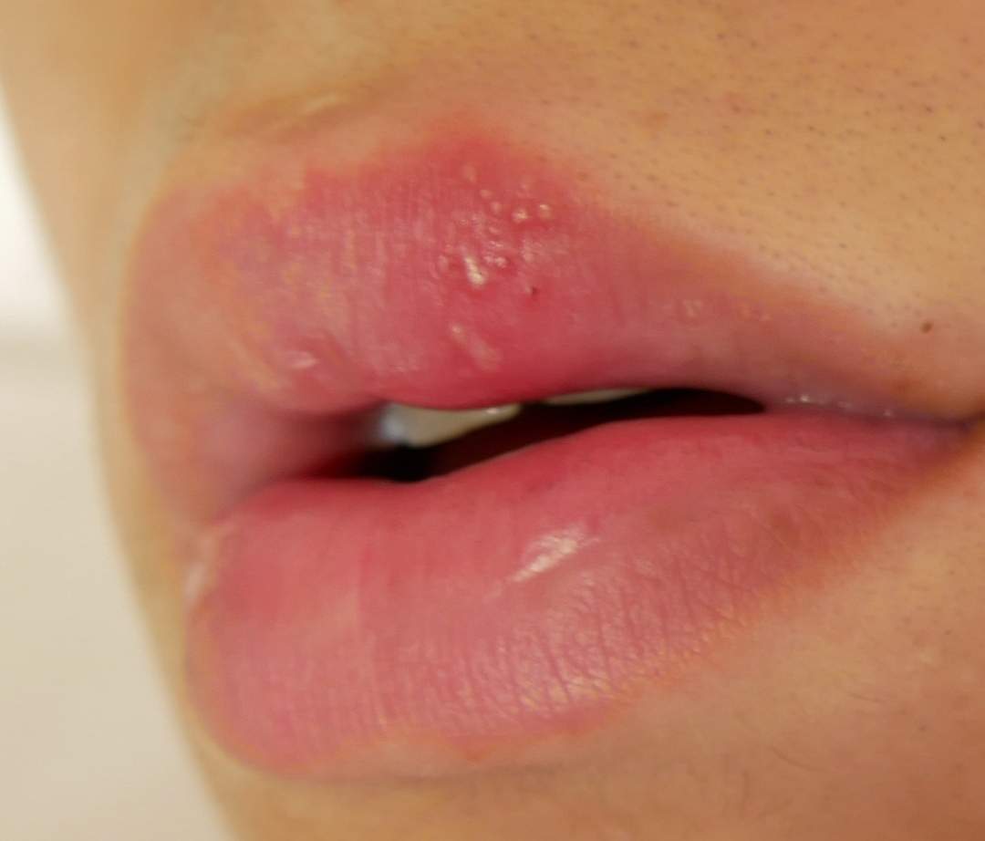 Lippe taub und geschwollen