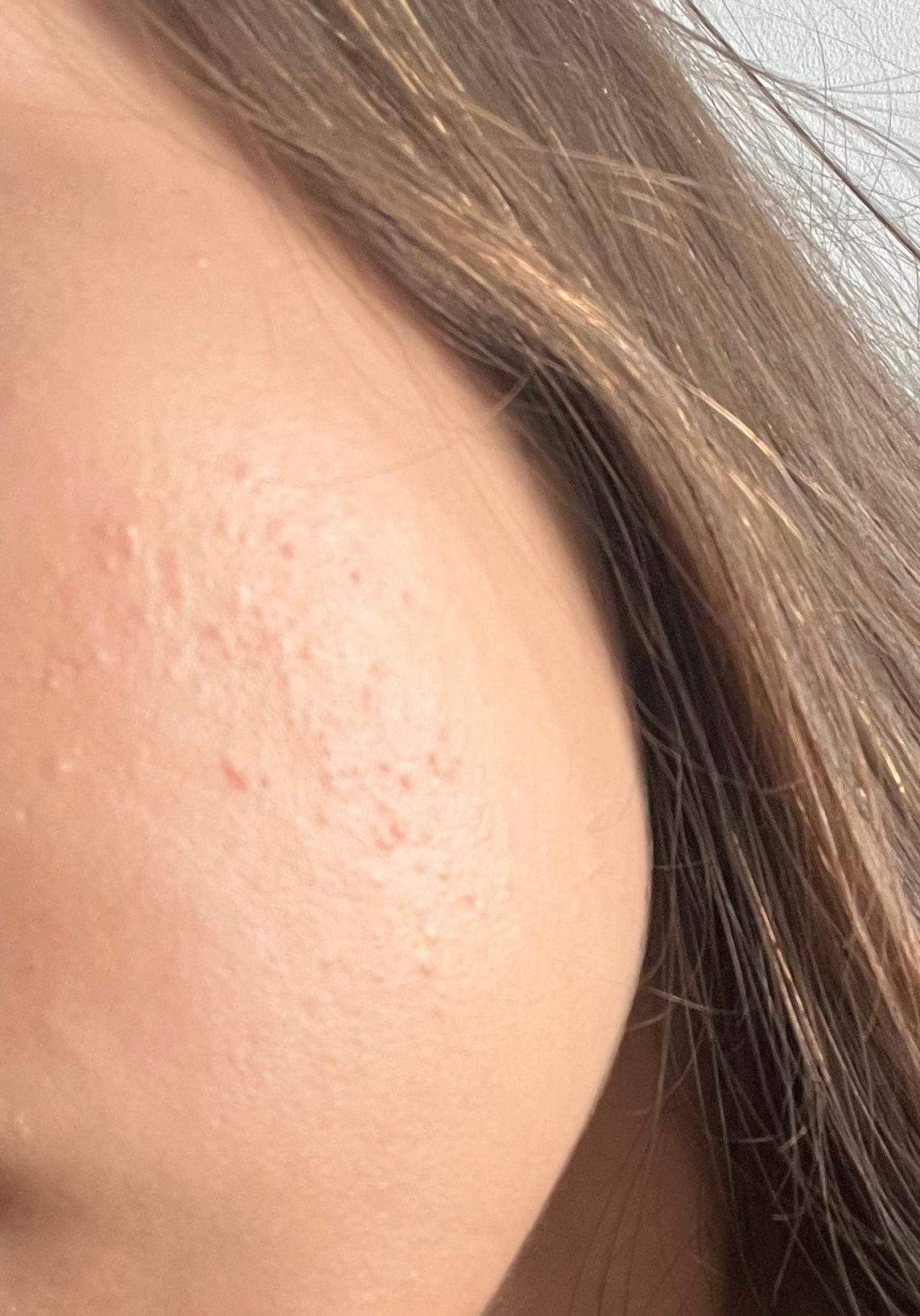 Kleine Pickel auf der Wange. Was ist das? (Haut) pickel auf der wange loswerden