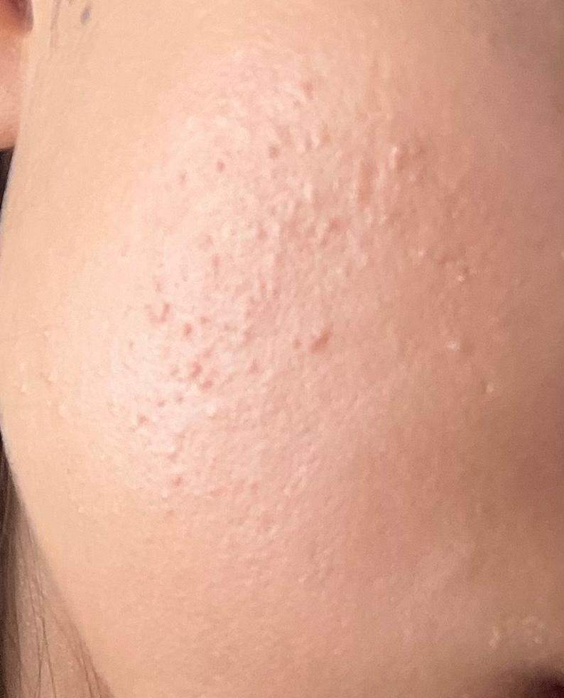 Kleine Pickel auf der Wange. Was ist das? (Haut) pickel auf der wange loswerden