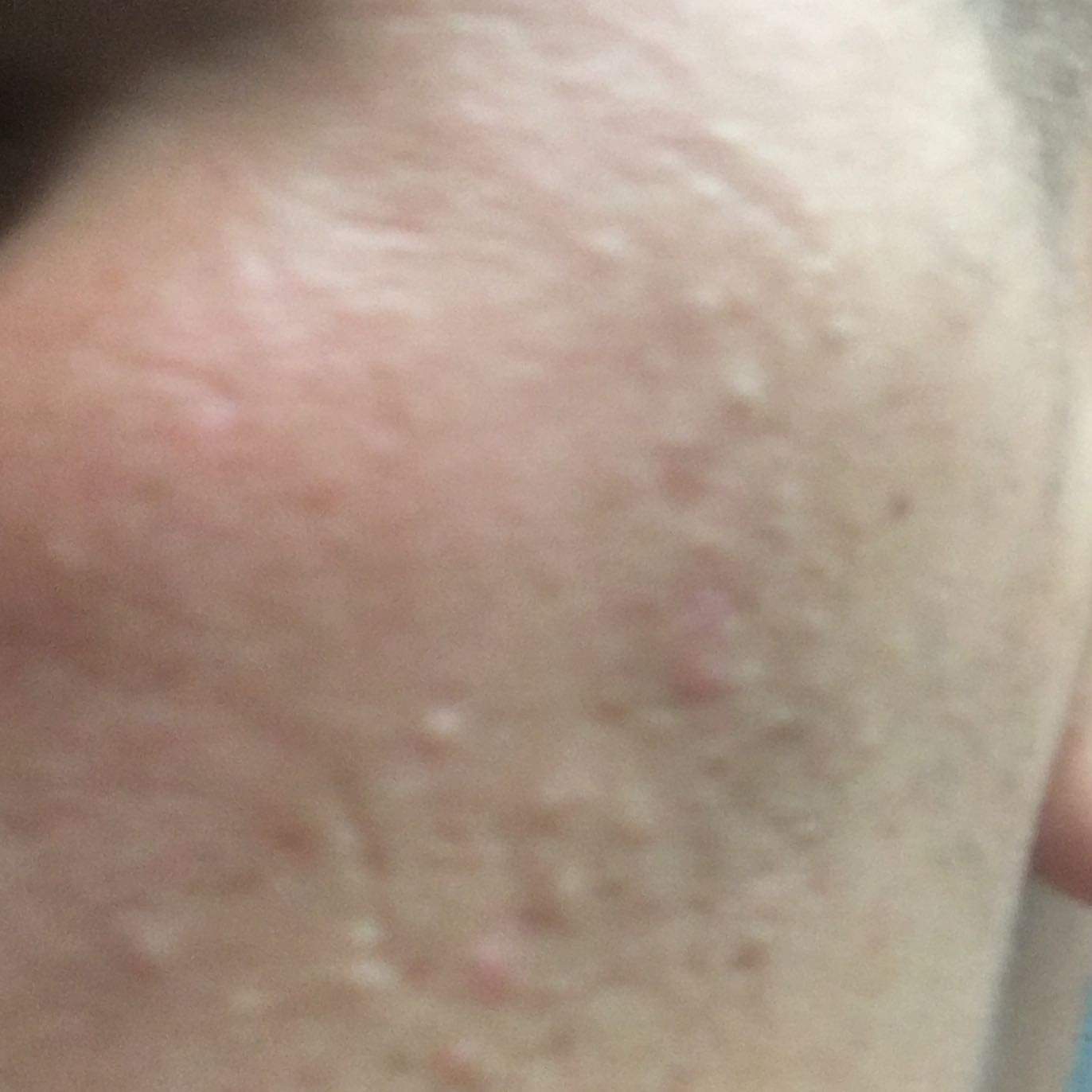 kleine Pickel im Bereich Stirn, Wangen, Mund ? (Haut, Hygiene, unreine Haut)