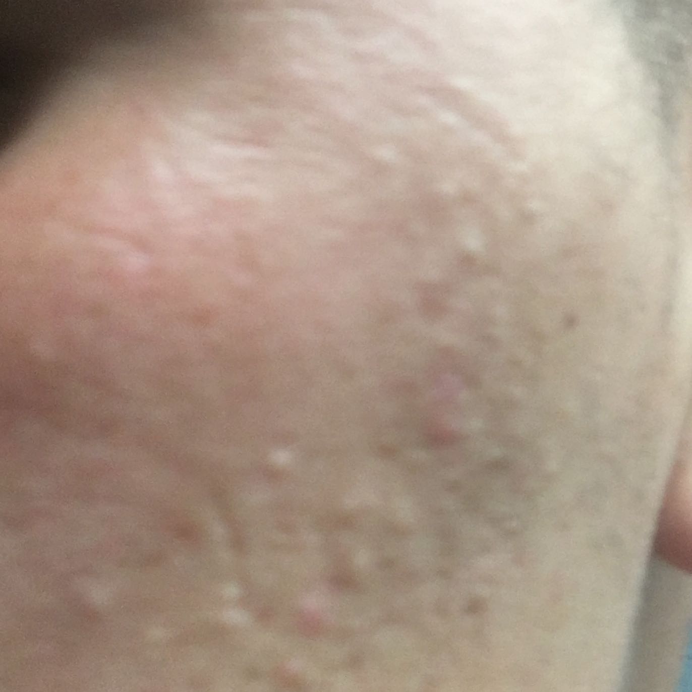 Download Kleine Pickel Im Mundwinkel Images