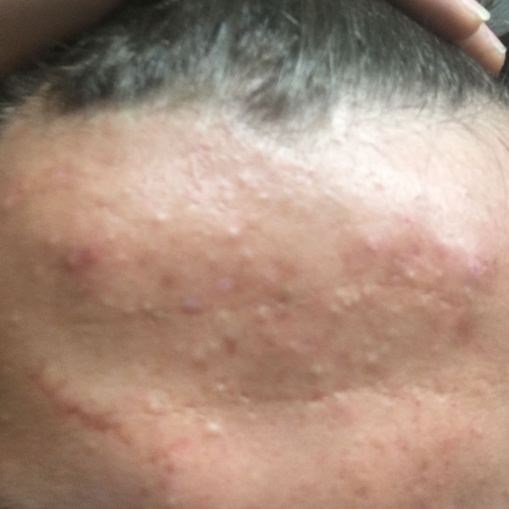 kleine Pickel im Bereich: Stirn, Wangen, Mund ? (Haut, Hygiene, gesucht) pickel an stirn