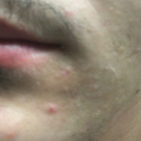 kleine Pickel im Bereich: Stirn, Wangen, Mund ? (Haut, Hygiene, gesucht) pickel am mund