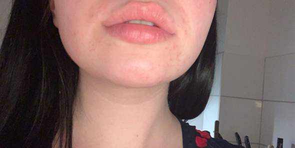 Download Pickel Im Mund Background