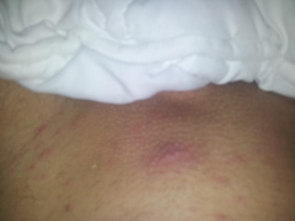 kleine pickel und eine grossere beule im