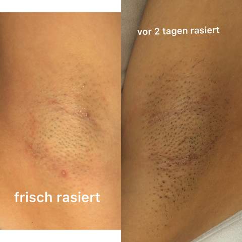 Kleine Pickel Unter Der Achsel Und Ausserdem Noch Stoppeln Gesundheit Und Medizin Madchen Beauty Kleine Pickel Unter Der Achsel Und Ausserdem Noch Stoppeln Gesundheit Und Medizin Madchen Beauty