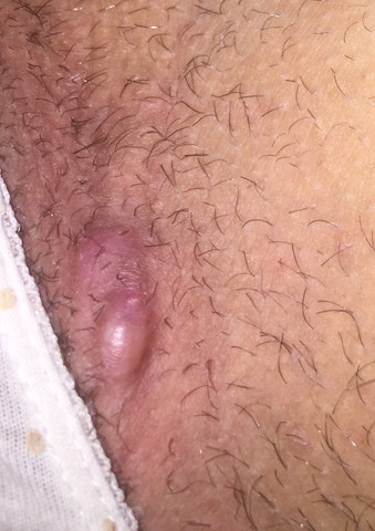 Kleine Pickelartige Beulen An Der Grenze Zwischen Intimbereich Und Oberschenkel Was Konnte Das Sein Gesundheit Arzt Hautprobleme Kleine Pickelartige Beulen An Der Grenze Zwischen Intimbereich Und Oberschenkel Was Konnte Das Sein Gesundheit Arzt Hautprobleme