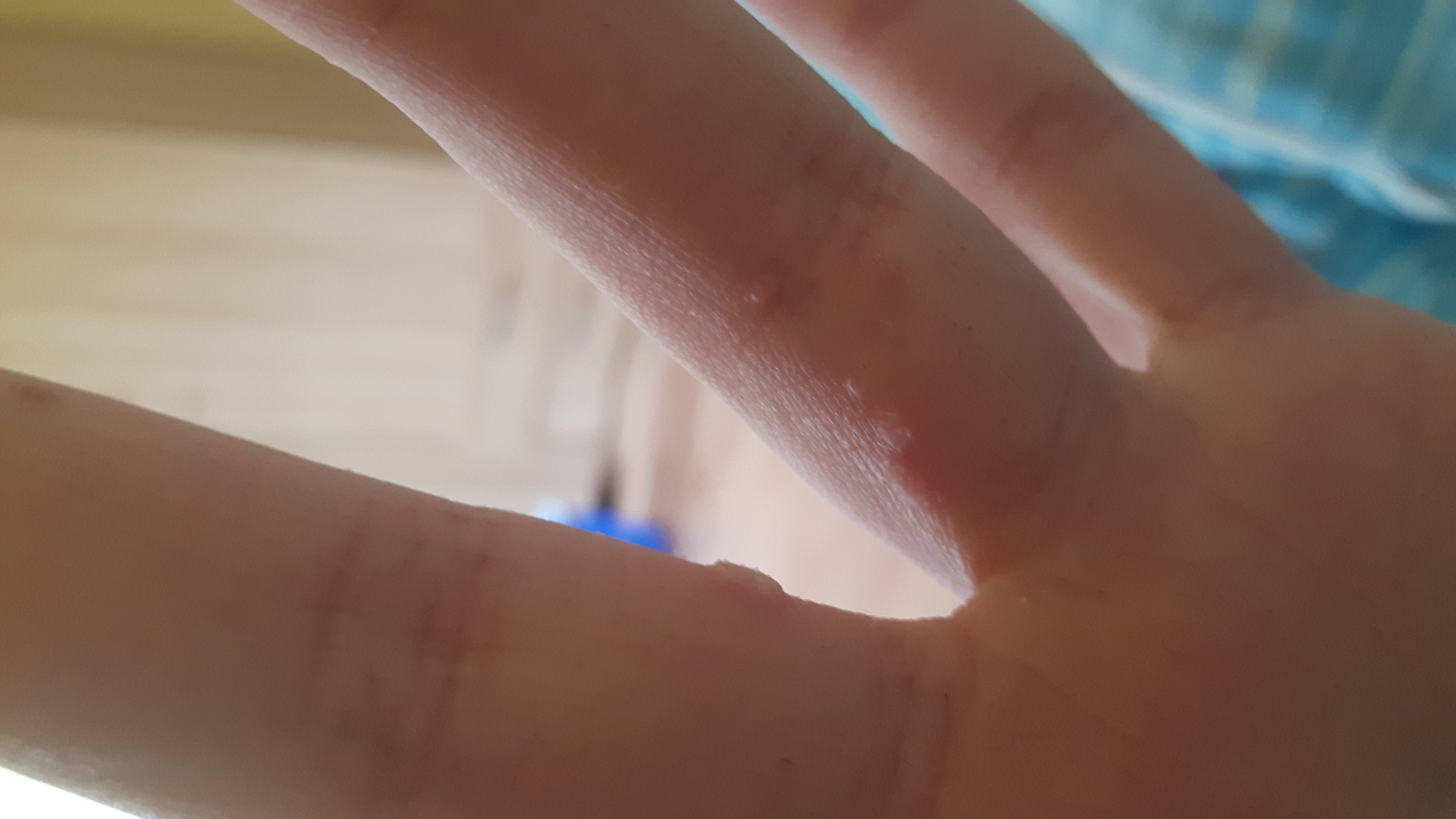 Hitzepickel Auf Finger Hitzepickel Auf Finger