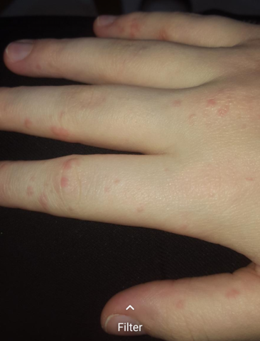 Kleine Pickelchen An Der Hand Ausschlag Was Ist Das Gesundheit Und Medizin Haut Finger Kleine Pickelchen An Der Hand Ausschlag Was Ist Das Gesundheit Und Medizin Haut Finger