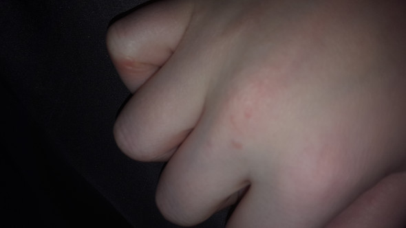 Kleine Pickelchen An Der Hand Was Ist Das Gesundheit Und Medizin Haut Pickel Kleine Pickelchen An Der Hand Was Ist Das Gesundheit Und Medizin Haut Pickel