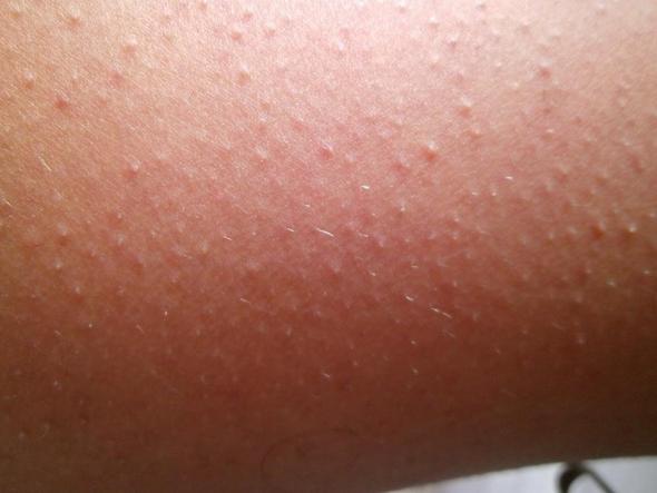 kleine Pickel'chen auf den Beinen, hilfe! (Beauty) pickel auf beinen