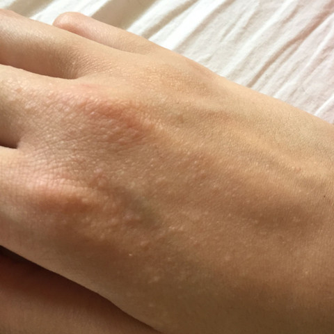 Kleine Pickelchen Auf Handrucken Sonnenallergie Sonne Kleine Pickelchen Auf Handrucken Sonnenallergie Sonne