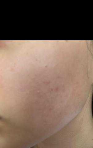 Kleine Pickel Rotungen Gehen Nicht Weg Was Tun Gesundheit Und Medizin Beauty Haut