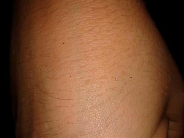 - (Medizin, Haut, Hand)