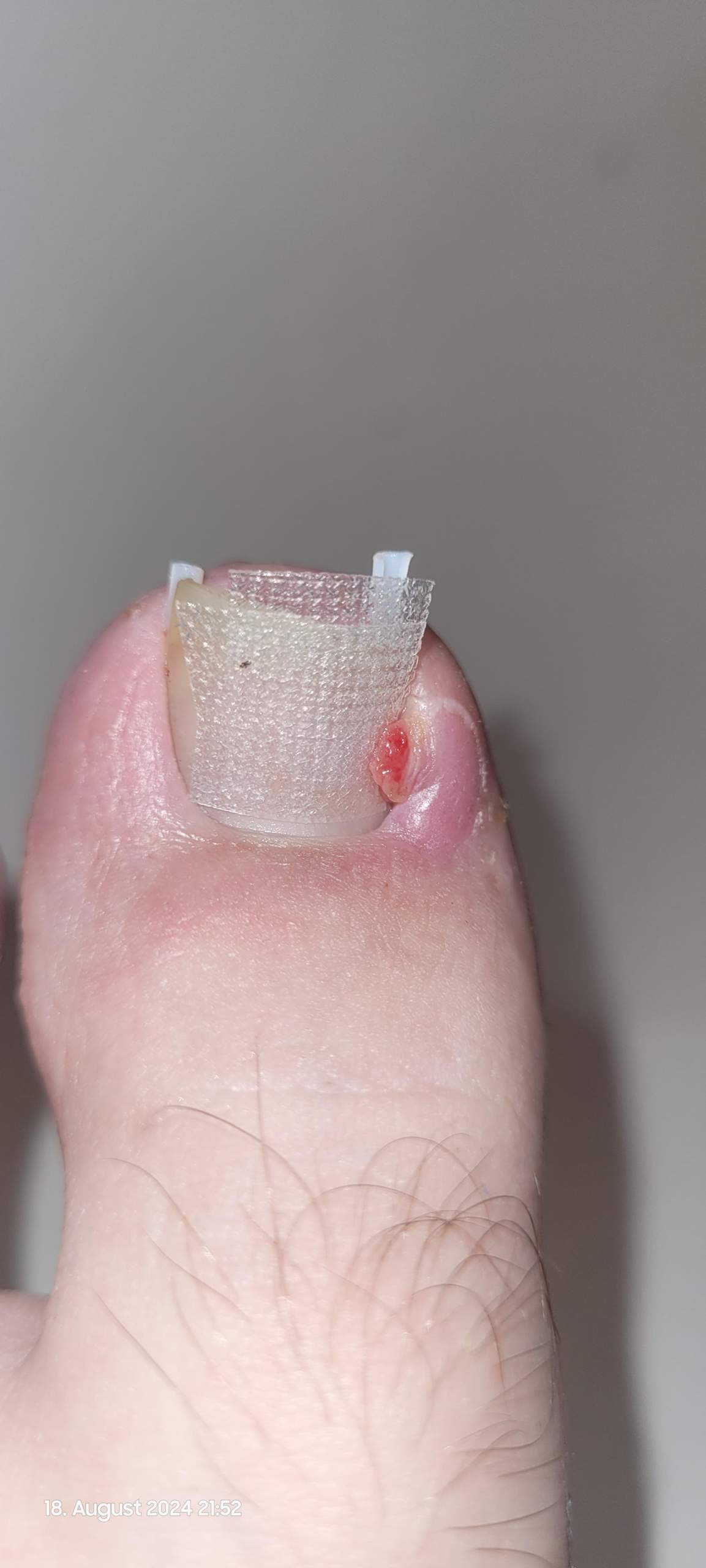 Kleine Rötung am großen Zeh? (Füße, Nägel)