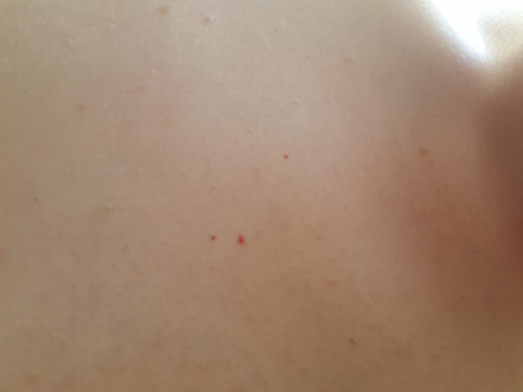 Kleine Rote Blutpunktchen Auf Oberarm Und Rucken Gesundheit Krankheit