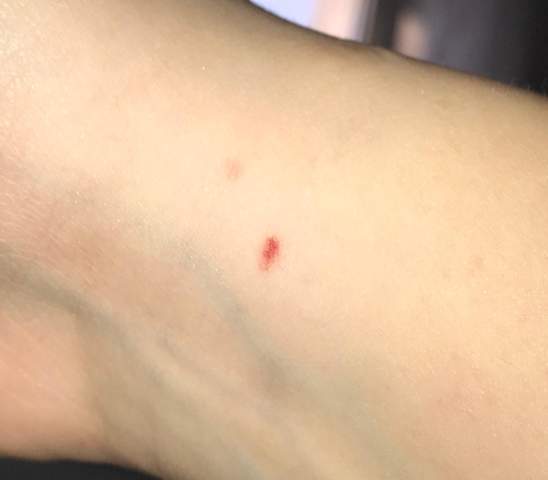 Kleine Rote Blutung Haut Kleine Rote Blutung Haut