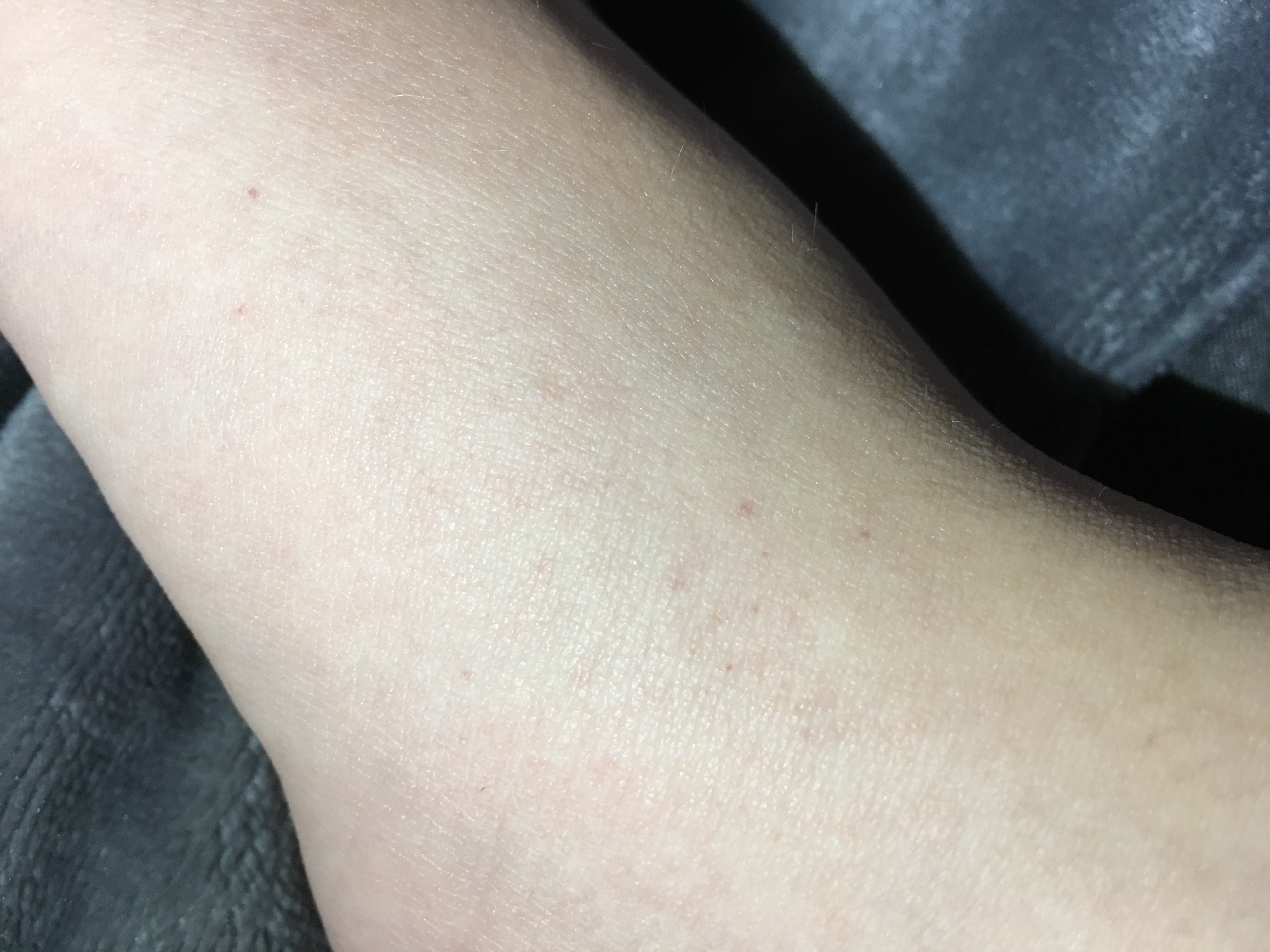 Kleine rote Flecken am Fuß (Juckend)? (Arzt, Haut, Füße)