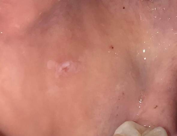 Kleine Rote Flecken Wunden Im Mund Was Ist Das Gesundheit Und Medizin Kleine Rote Flecken Wunden Im Mund Was Ist Das Gesundheit Und Medizin