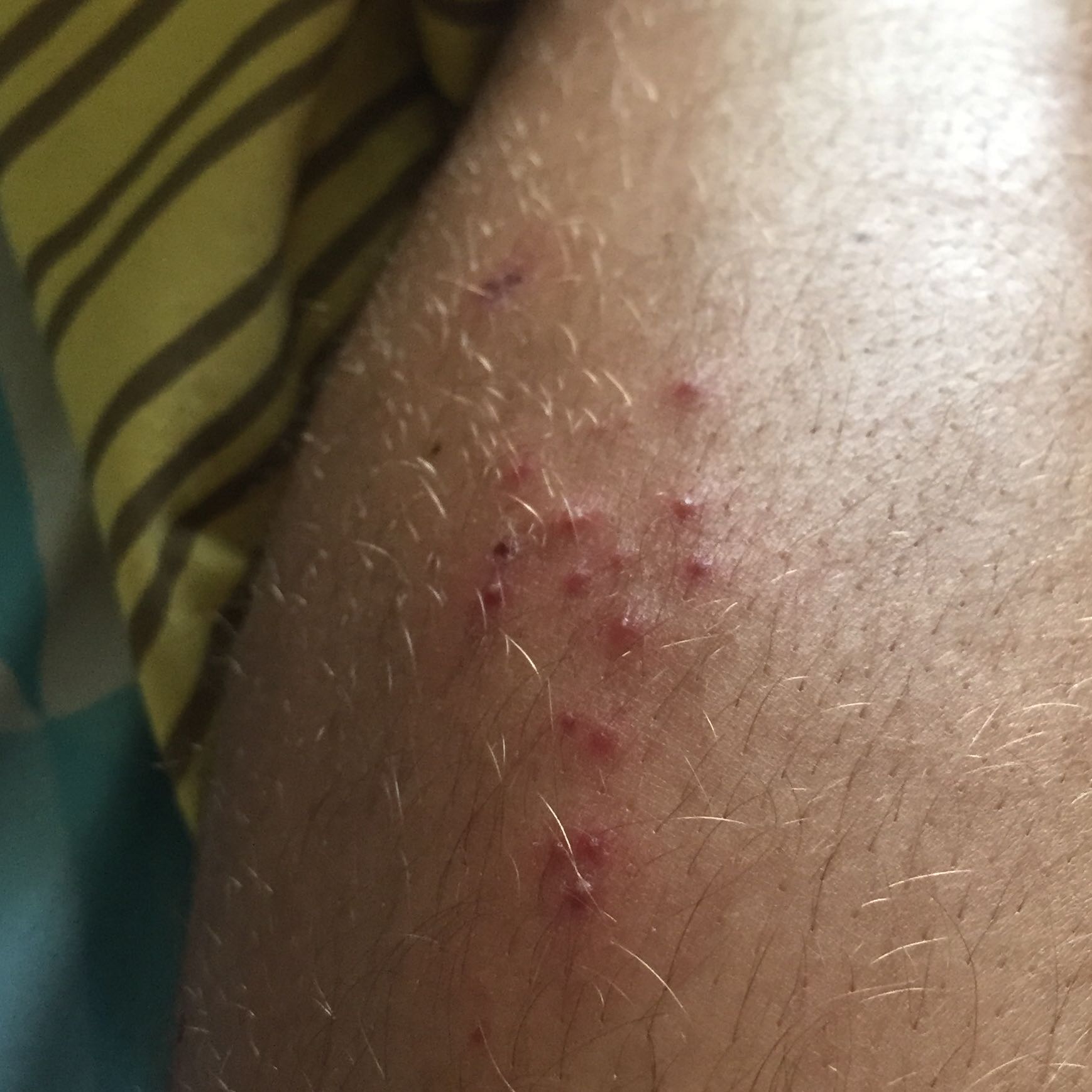 View Pickel Im Ohrläppchen Was Tun PNG