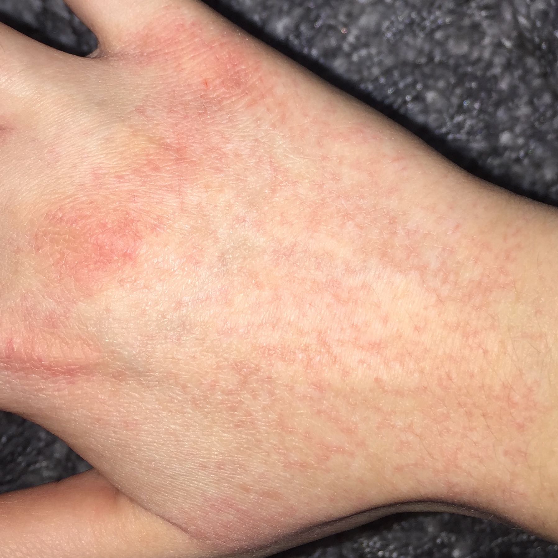 Kleine rote Pünktchen auf der Hand? (Gesundheit, Allergie, Ausschlag)