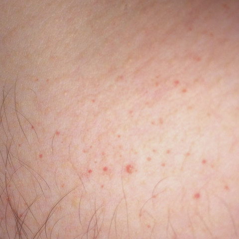 Kleine Rote Punkte Auf Der Brust Was Kann Das Sein Gesundheit Krankheit Ausschlag Kleine Rote Punkte Auf Der Brust Was Kann Das Sein Gesundheit Krankheit Ausschlag
