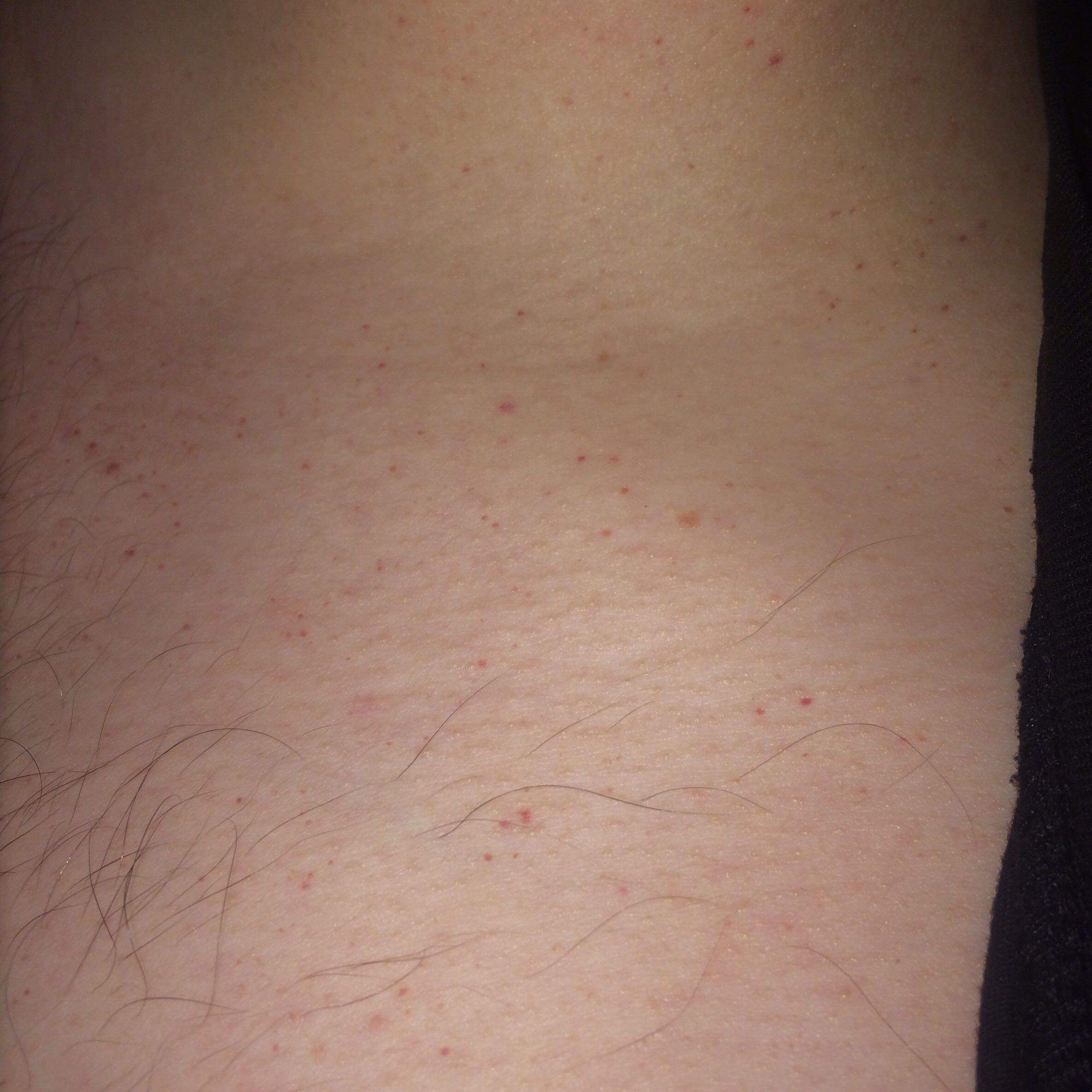 Kleine rote Punkte auf der Brust. Was kann das sein? (Gesundheit