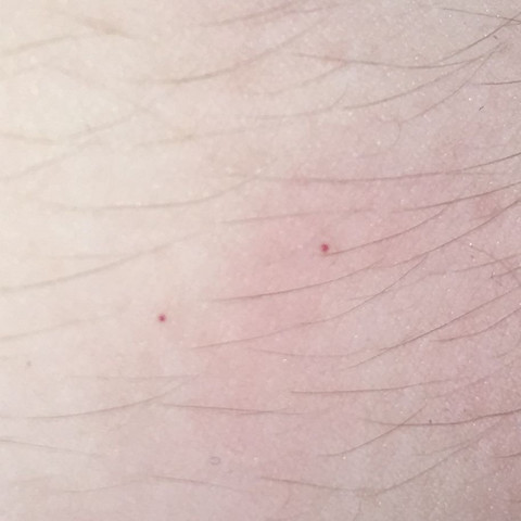 Kleine Rote Punkte Auf Meinem Ganzen Arm Menschen Blut Gesund Kleine Rote Punkte Auf Meinem Ganzen Arm Menschen Blut Gesund