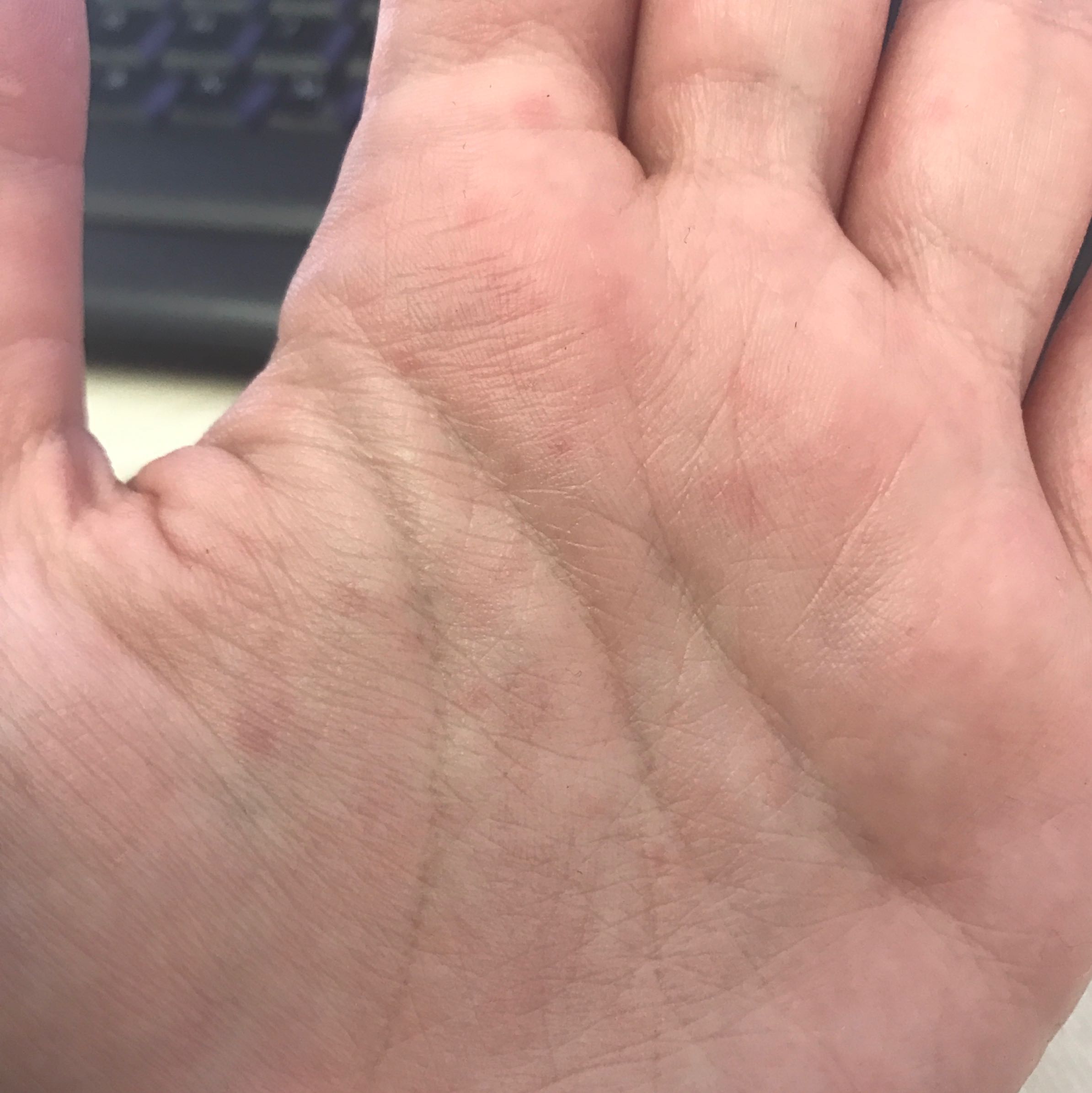 Kleine rote Punkte bei den Handinnenflächen? (Gesundheit und Medizin