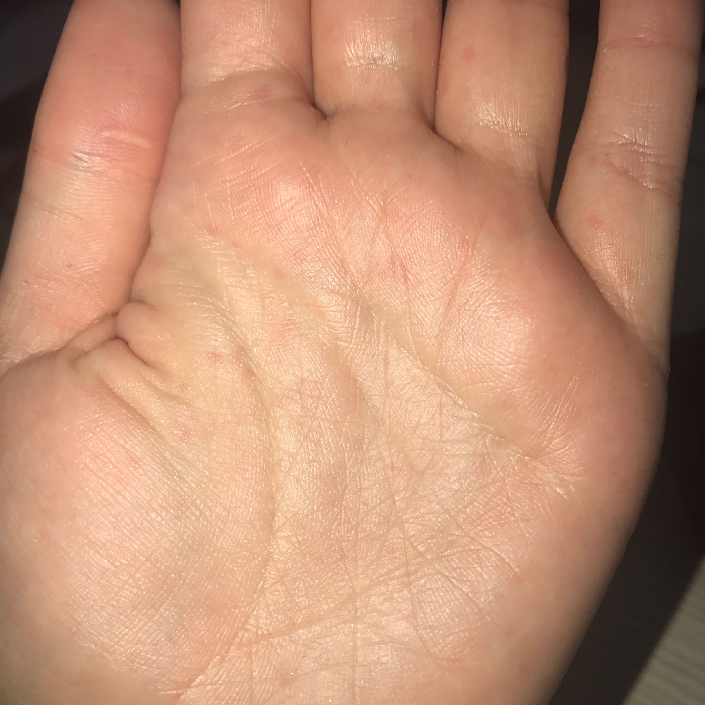 Kleine rote Punkte bei den Handinnenflächen? (Gesundheit und Medizin, Hand, rotepunkte) Kleine rote Punkte bei den Handinnenflächen? (Gesundheit und Medizin, Hand, rotepunkte)