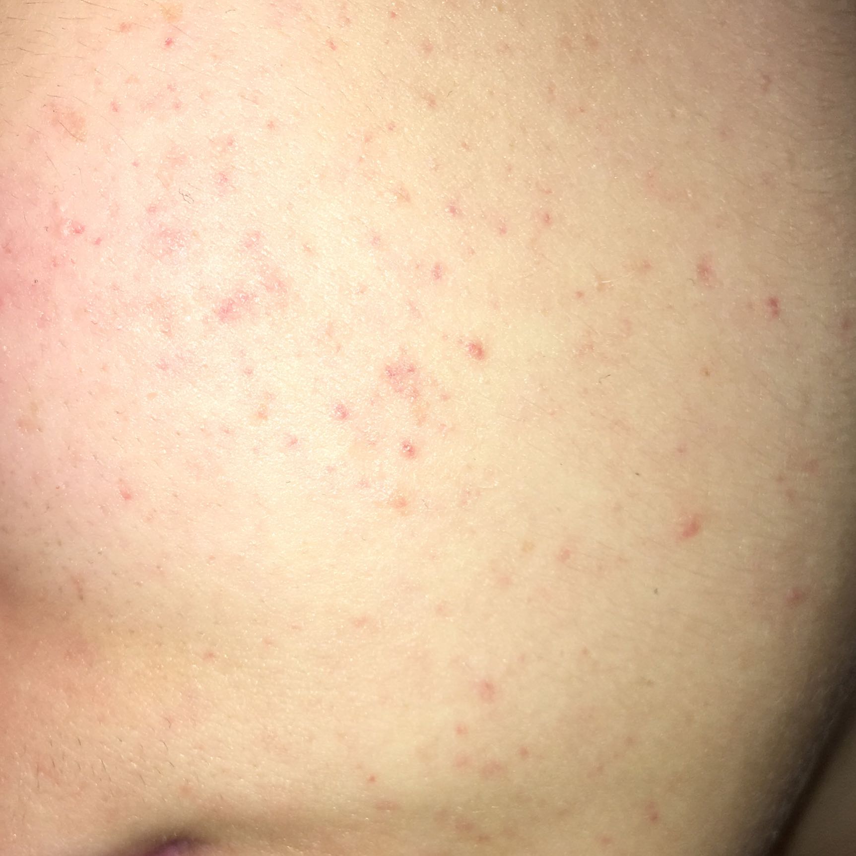 View Rote Flecken Nach Pickel Ausdrücken PNG