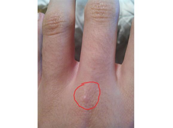 Kleine Rote Stiche Woher Insekten Bett Schadlinge Kleine Rote Stiche Woher Insekten Bett Schadlinge