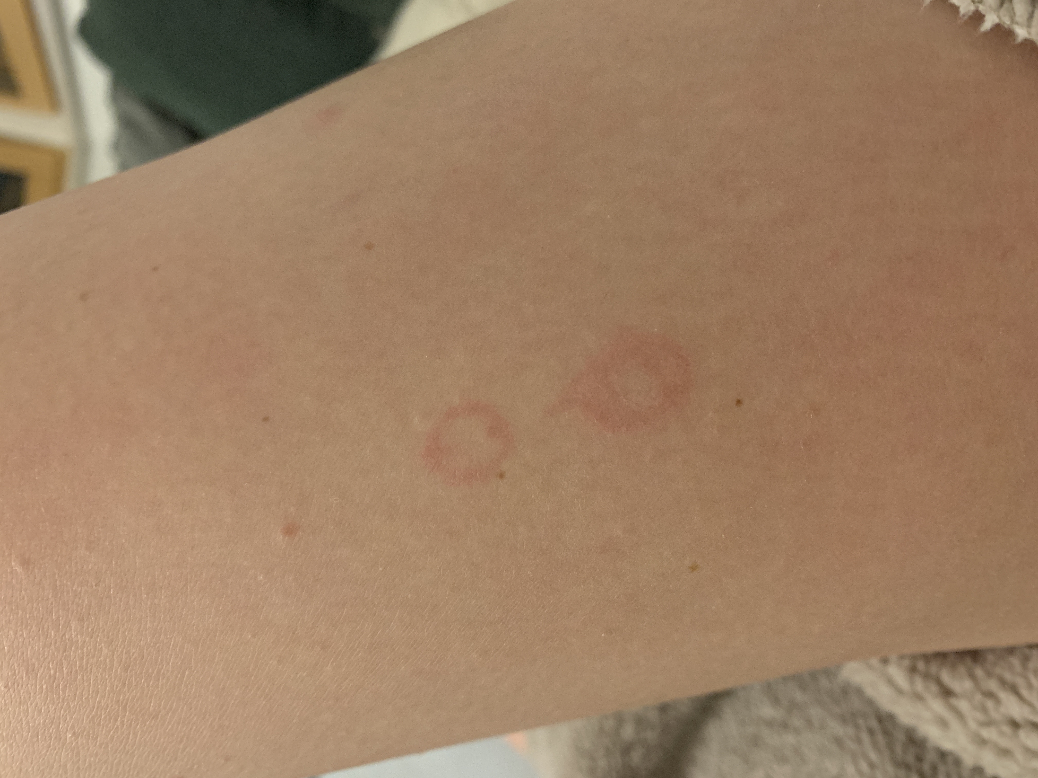 kleine runde rote Kreise am Bein? (Gesundheit)