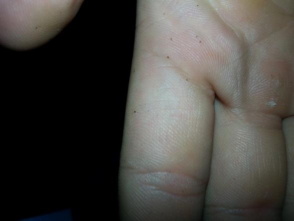 kleine schwarze Flecken auf der Hand.