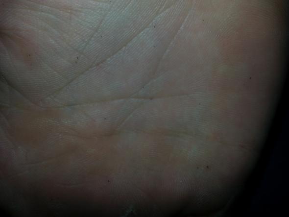 Kleine Schwarze Flecken Auf Der Hand Gesundheit Arzt Krankheit Kleine Schwarze Flecken Auf Der Hand Gesundheit Arzt Krankheit
