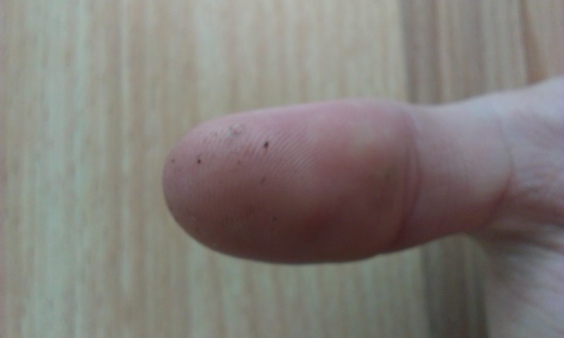 Kleine Schwarze Punkte Auf Den Handen Arbeit Krankheit Hand Kleine Schwarze Punkte Auf Den Handen Arbeit Krankheit Hand