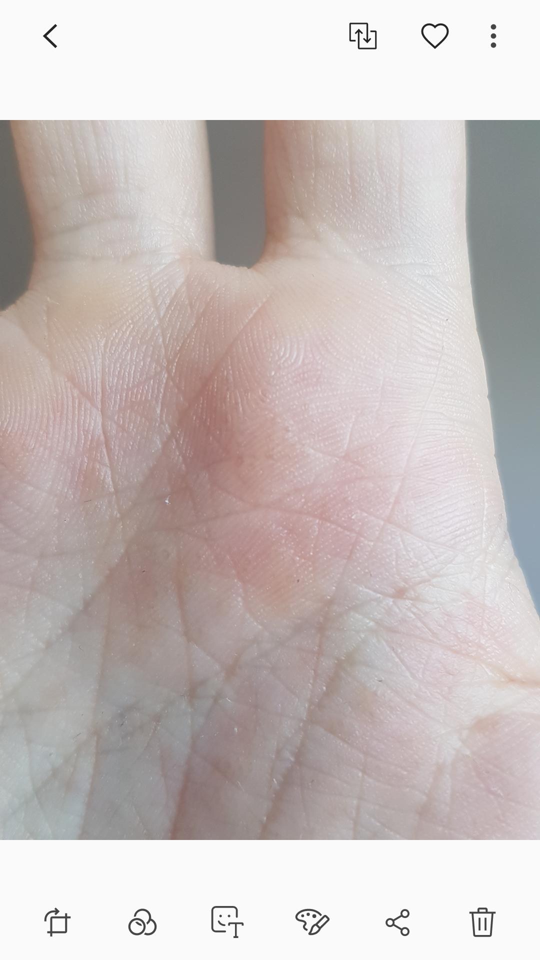 Kleine Bläschen Auf Der Hand Nicht Juckend